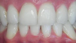 blanqueamiento dental enzimático