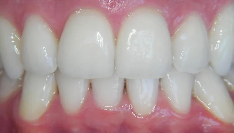 blanqueamiento dental enzimático