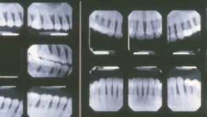 enfermedad periodontal y piorrea