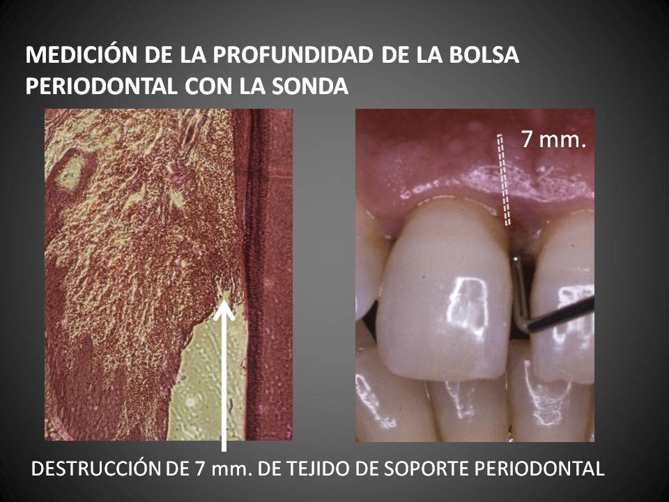 sal sin cable marca bolsa periodontal - Martinez Canut - Clínica Dental Valencia