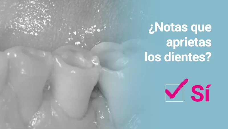 férula descarga bruxismo - Martinez Canut - Clínica Dental Valencia